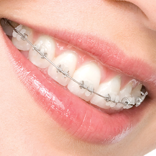 zahnzoo feste spangen selbstlegierende brackets